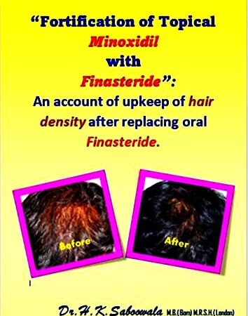 “Fortification of Topical Minoxidil with Finasteride”: An account of upkeep of hair density after replacing oral Finasteride. (English Edition)